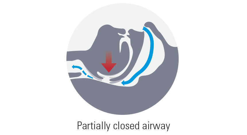 Types of sleep apnea